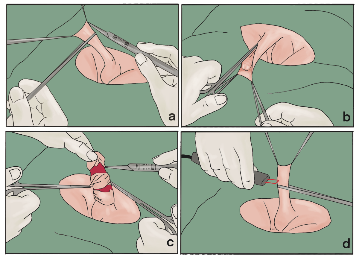quy-trinh-cat-bqd.png?v=1775621043710 Cắt bao quy đầu là gì?