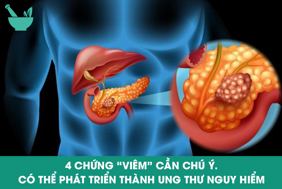 4 CHỨNG “VIÊM” CẦN CHÚ Ý. CÓ THỂ PHÁT TRIỂN THÀNH UNG THƯ NGUY HIỂM