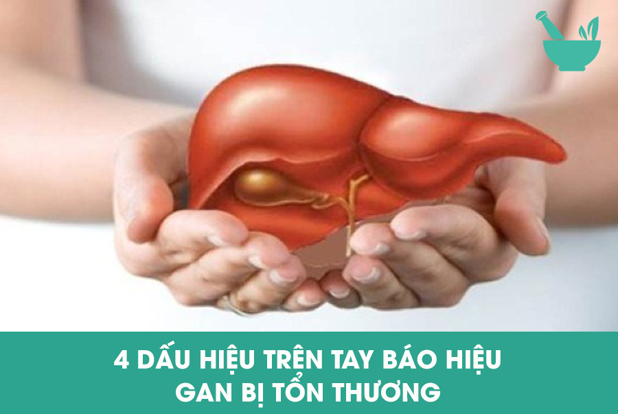 4 DẤU HIỆU TRÊN TAY BÁO HIỆU GAN BỊ TỔN THƯƠNG