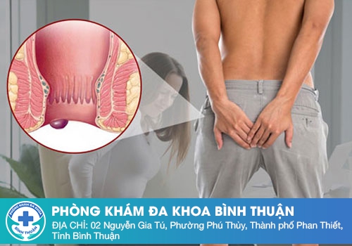 Mắc Bệnh Trĩ Ngoại Độ 1 Có Nguy Hiểm Không?