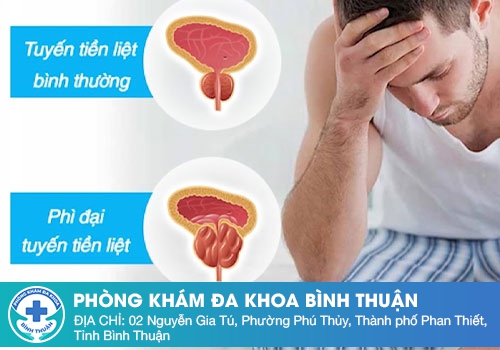 Phì Đại Tuyến Tiền Liệt Có Nguy Hiểm Hay Không? Nguy Cơ Cần Lưu Ý