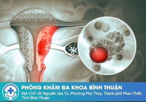 Viêm Nội Mạc Tử Cung Sau Sinh - Mối Nguy Hiểm Không Thể Xem Nhẹ