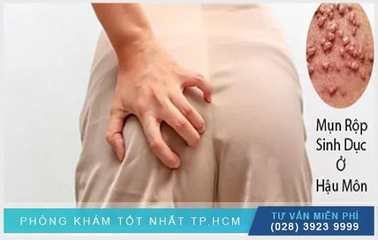 Thông Tin Quan Trọng Về Mụn Rộp Sinh Dục Ở Hậu Môn Bạn Cần Biết