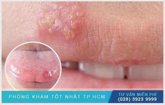 Dấu Hiệu Và Cách Phòng Ngừa Nhiệt Miệng Herpes