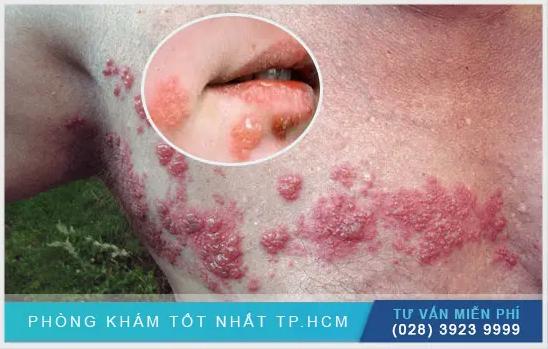 Cảnh Báo: Nguy Cơ Nhiễm Herpes Khi Xăm Môi Và Những Điều Cần Biết