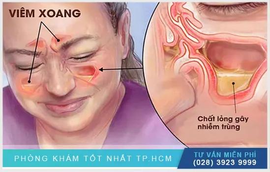 Mủ Viêm Xoang Có Máu Nguy Hiểm Như Thế Nào? Cách Điều Trị Hiệu Quả