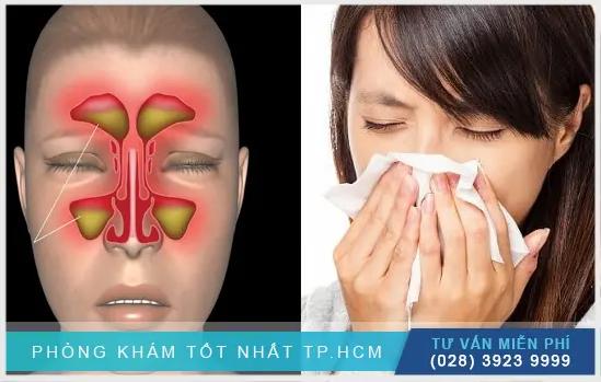 Phương Pháp Điều Trị Viêm Xoang Có Mủ Tại Nhà Dễ Thực Hiện