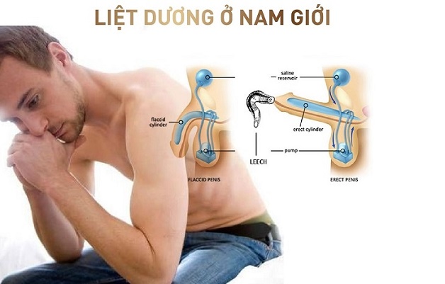 Liệt dương: Nguyên nhân và cách chữa bệnh liệt dương hiệu quả