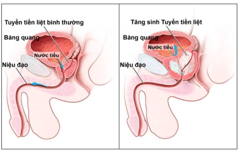 viêm tuyến tiền liệt