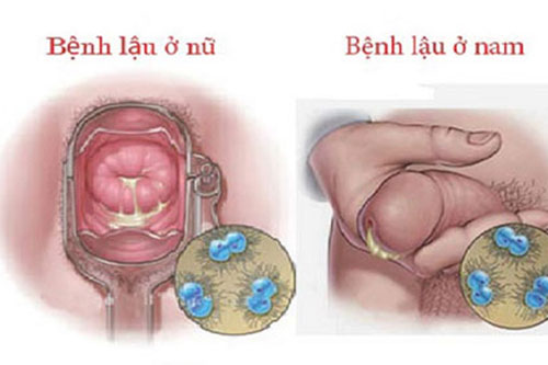 Bệnh lậu là gì