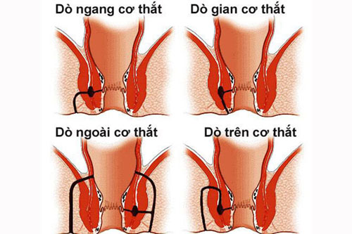 Bệnh rò hậu môn là gì