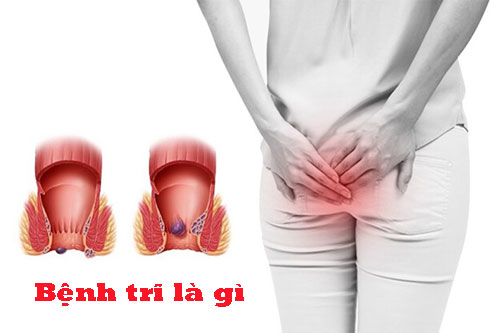 Bệnh trĩ là gì