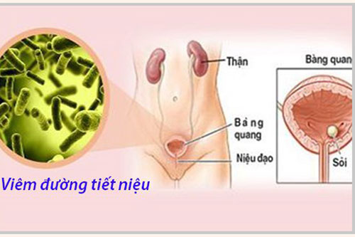 Bệnh viêm đường tiết niệu