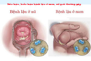 12 Dấu hiệu bệnh lậu ở nam giới và nữ giới cần thăm khám ngay