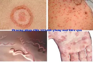 12 Cách chữa trị bệnh giang mai hiệu quả nhất tại nhà