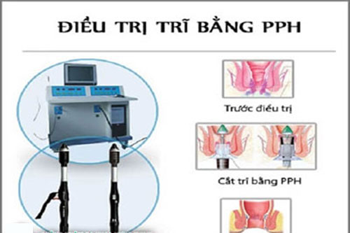 Chữa bệnh trĩ bằng phương pháp PPH