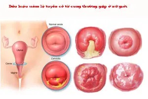 10 Triệu chứng của viêm lộ tuyến cổ tử cung thường gặp