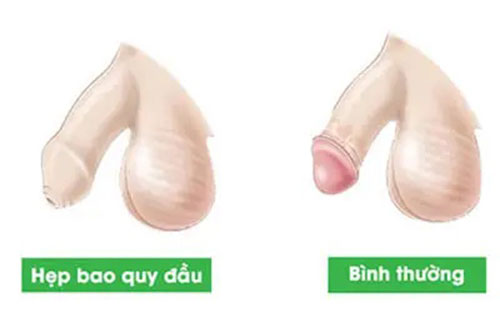 Hẹp bao quy đầu là gì?