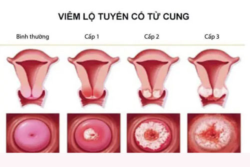 Hình ảnh viêm lộ tuyến cổ tử cung cấp độ 1,2,3