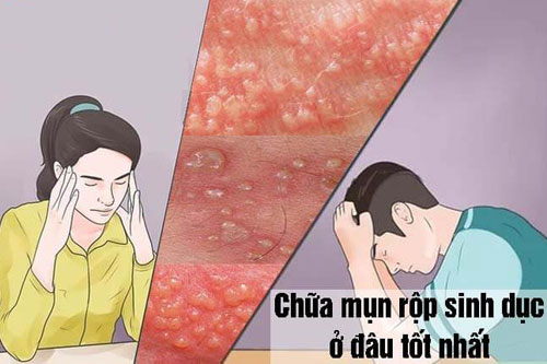 chữa mụn rộp dinh dục ở đâu tốt nhất