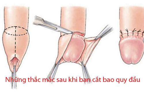 Những thắc mắc sau khi bạn cắt bao quy đầu