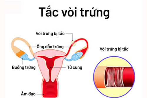 Tắc vòi trứng