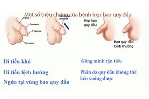 Triệu chứng của bệnh hẹp bao quy đầu