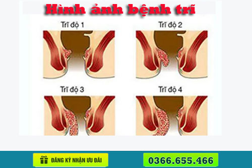 12 Hình ảnh bệnh trĩ nội, trĩ ngoại, trĩ hỗn hợp