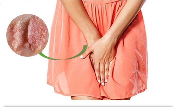 Phòng khám điều trị sùi mào gà ở nữ uy tín tại Hà Nội