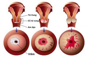 Chữa Viêm lộ tuyến cổ tử cung tận gốc không cần phẫu thuật với Luận Trị Đông Y