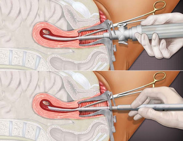 Tìm hiểu phá thai không đau bằng cách nào tốt nhất