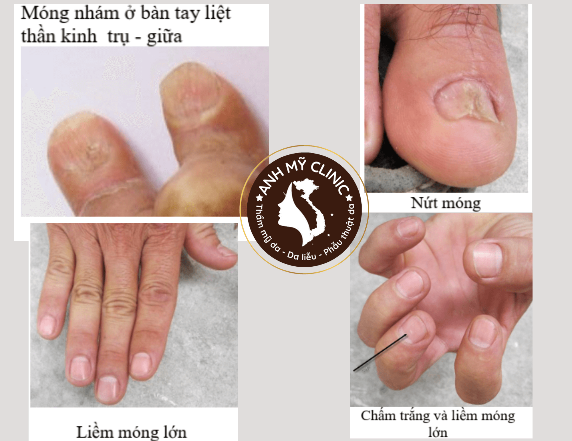 Hình dạng tổn thương móng trong bệnh phong 2