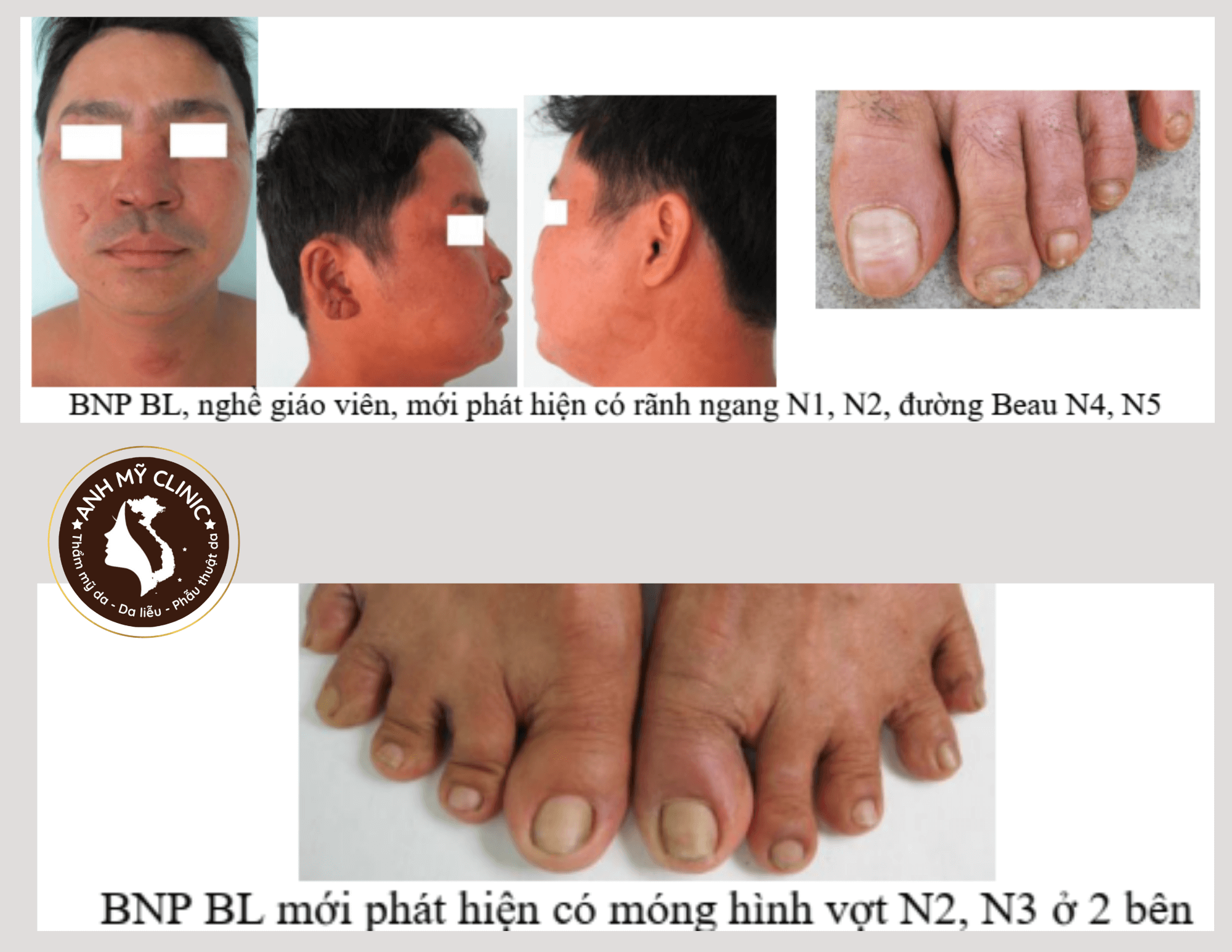 Hình dạng tổn thương móng trong bệnh phong 13