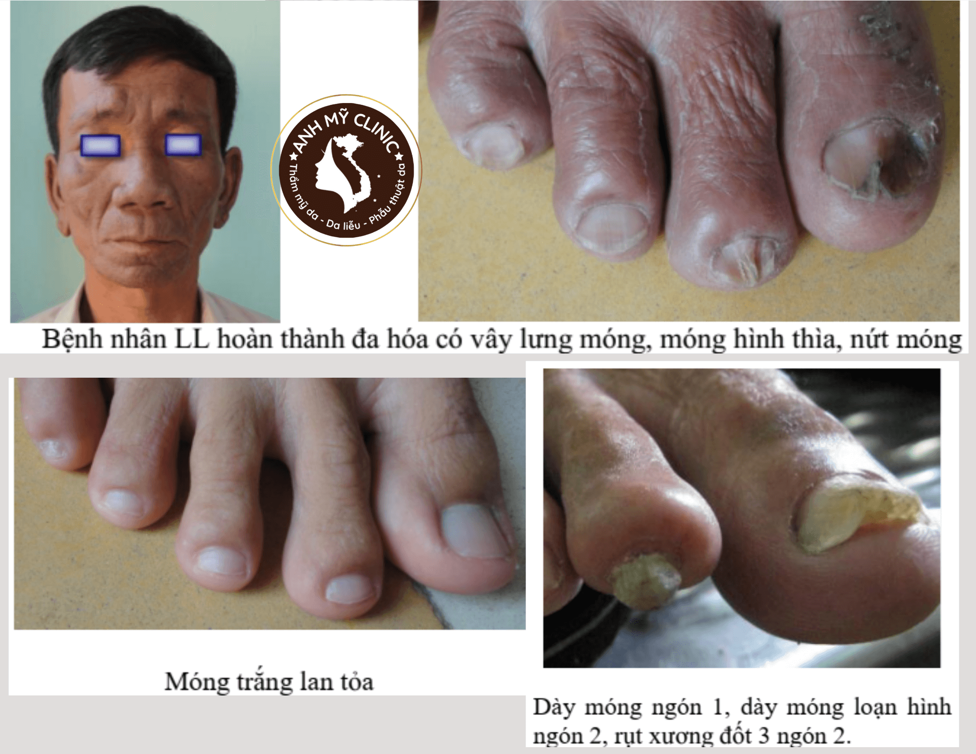 Hình dạng tổn thương móng trong bệnh phong 4