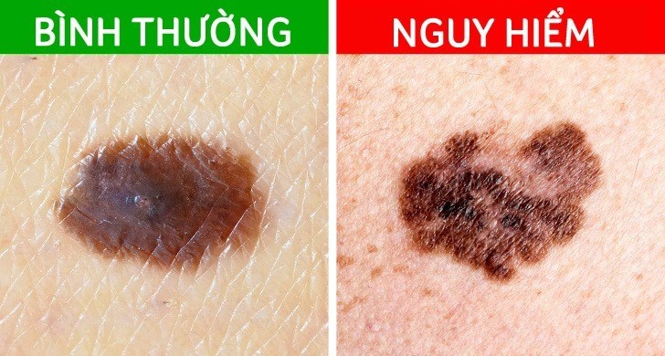 Bí Ẩn Phía Sau Nốt Ruồi: Khi Nào Nên Lo Lắng về Ung Thư Melanoma?