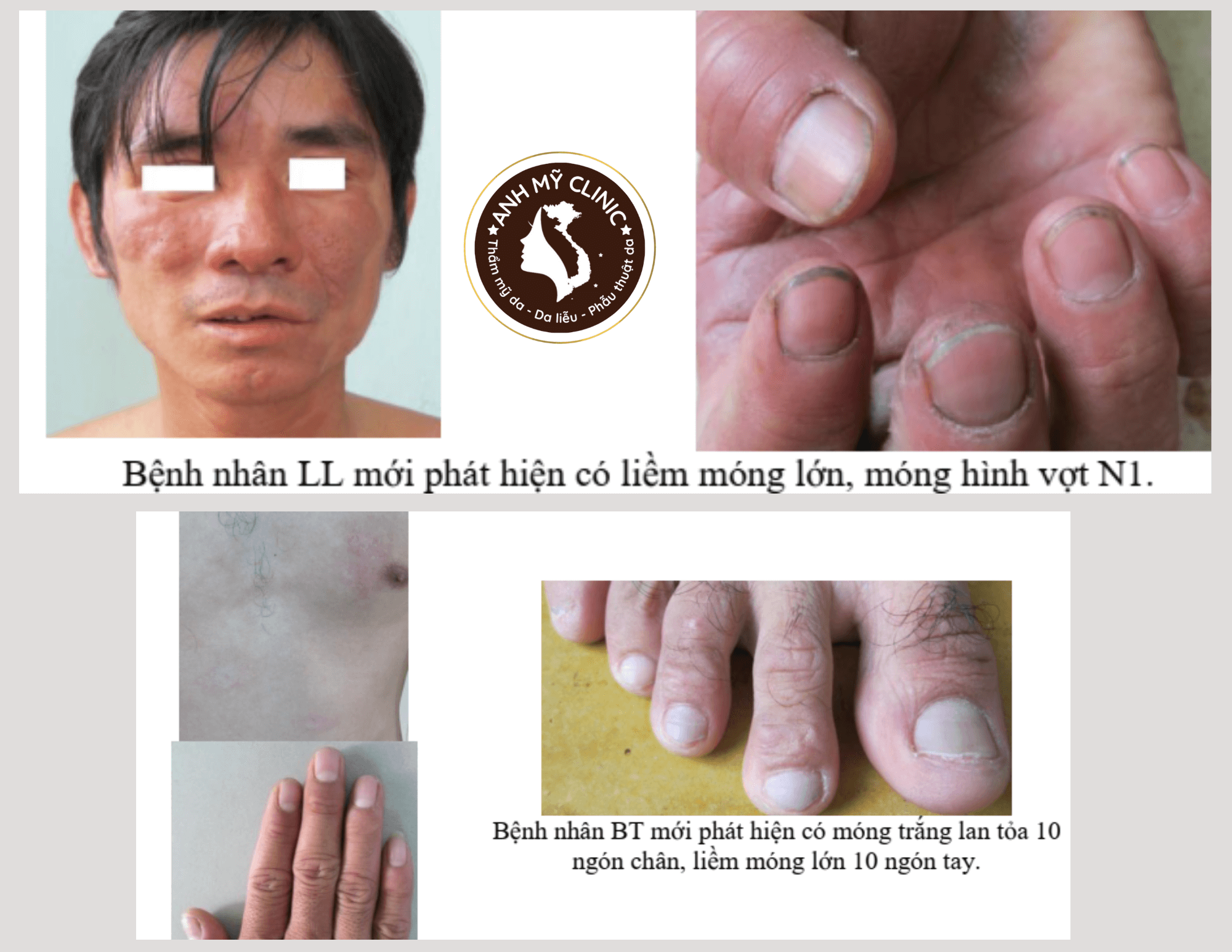 Hình dạng tổn thương móng trong bệnh phong 7