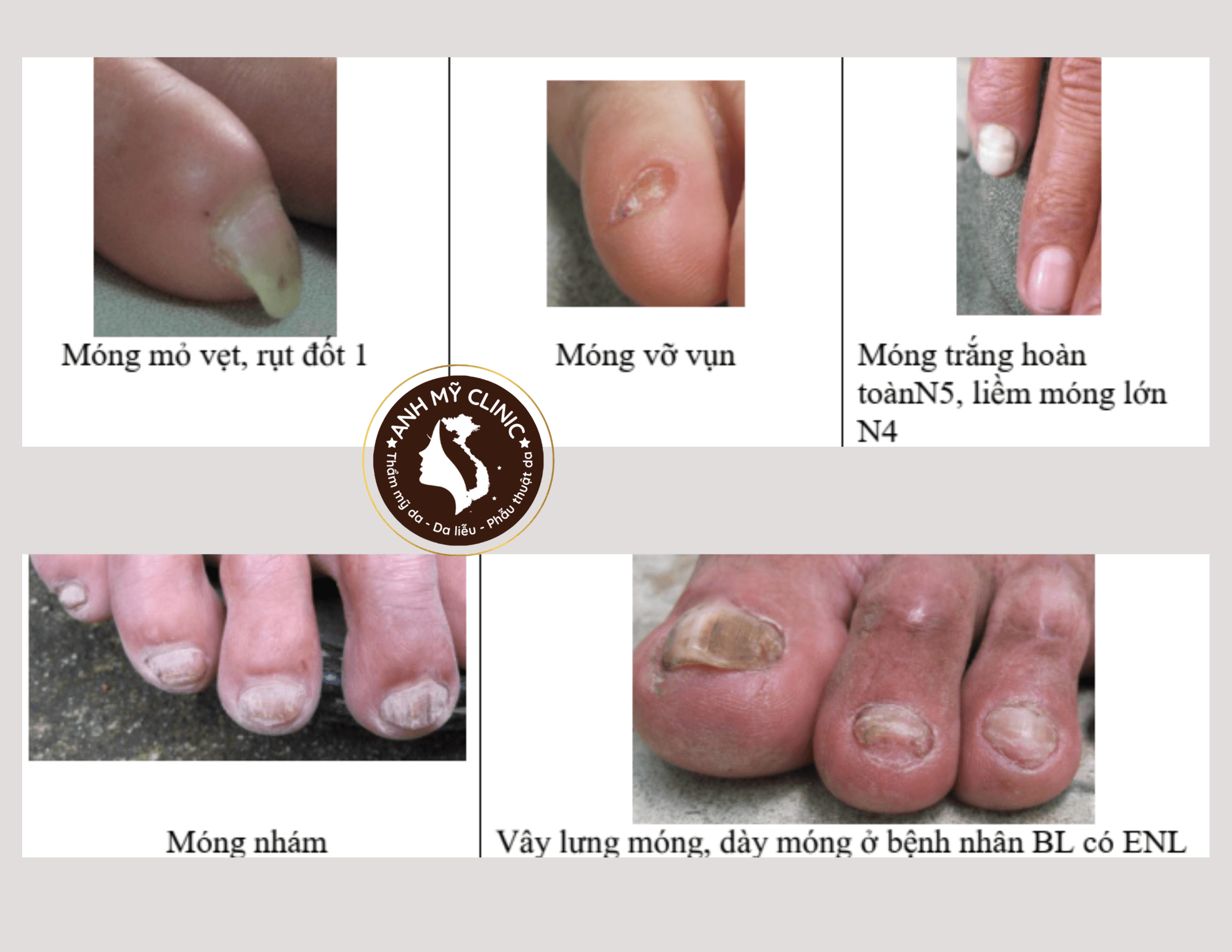 Hình dạng tổn thương móng trong bệnh phong 9