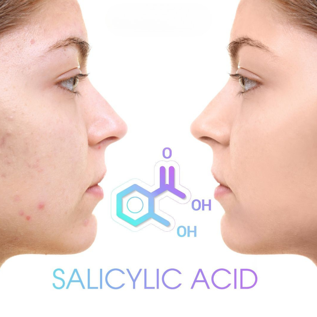 Chữa Mụn Trứng Cá Hiệu Quả Với Salicylic Acid 2% | PK Da Liễu Anh Mỹ