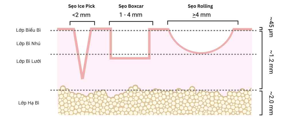 Các loại sẹo mụn