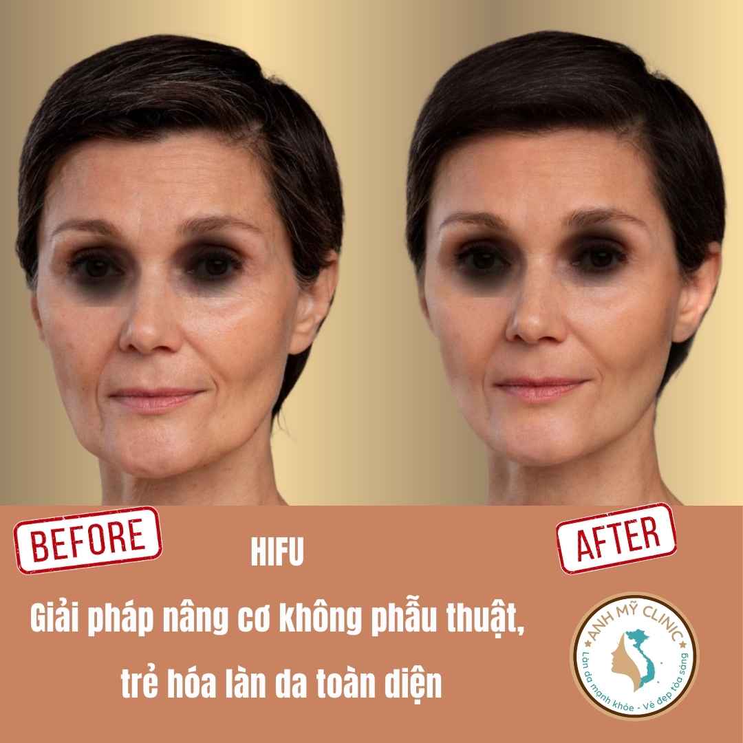 amc-hifu.jpg?v=1 HIFU trẻ hóa da, nâng cơ