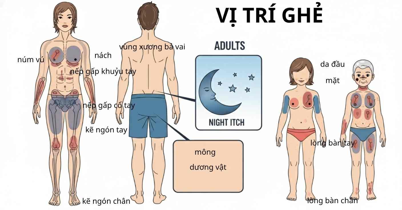 Bản đồ vị tr&iacute; tổn thương bệnh ghẻ ở người lớn v&agrave; trẻ nhỏ