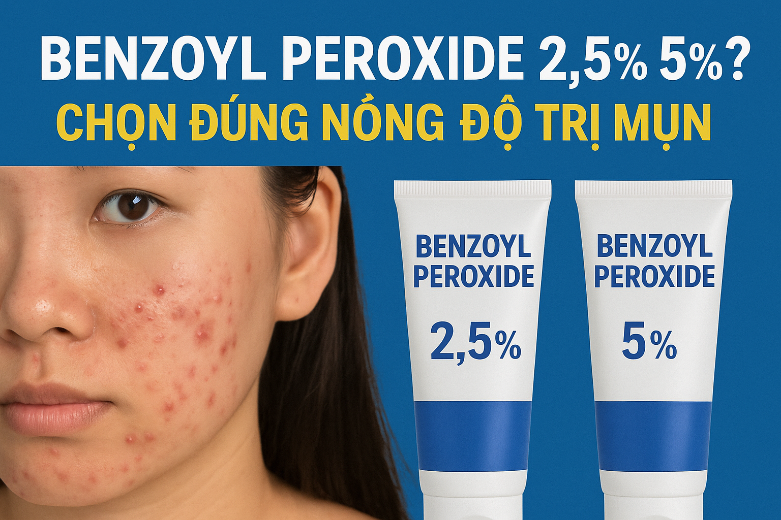 Benzoyl Peroxide 2,5% hay 5%? Chọn đúng nồng độ trị mụn
