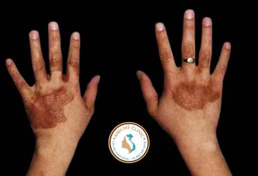 viem-da-tiep-xuc-anh-sang-tinh-dau-chanh.jpg Viêm da tiếp xúc ánh sáng do tinh dầu chanh