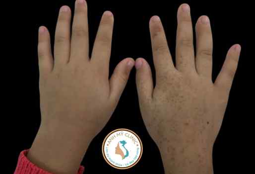 Viêm Da Tiếp Xúc Ánh Sáng Berloque - Nguyên Nhân & Cách Điều Trị