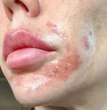 bong-sau-peel-da.jpg Bỏng sau peel da