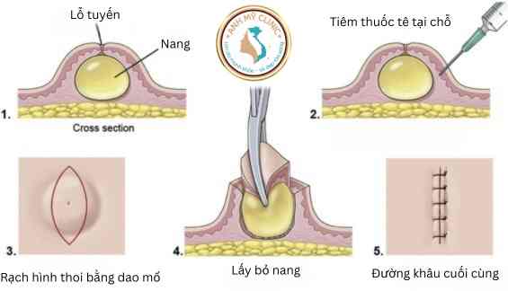 C&aacute;c bước cắt bỏ u nang biểu b&igrave;