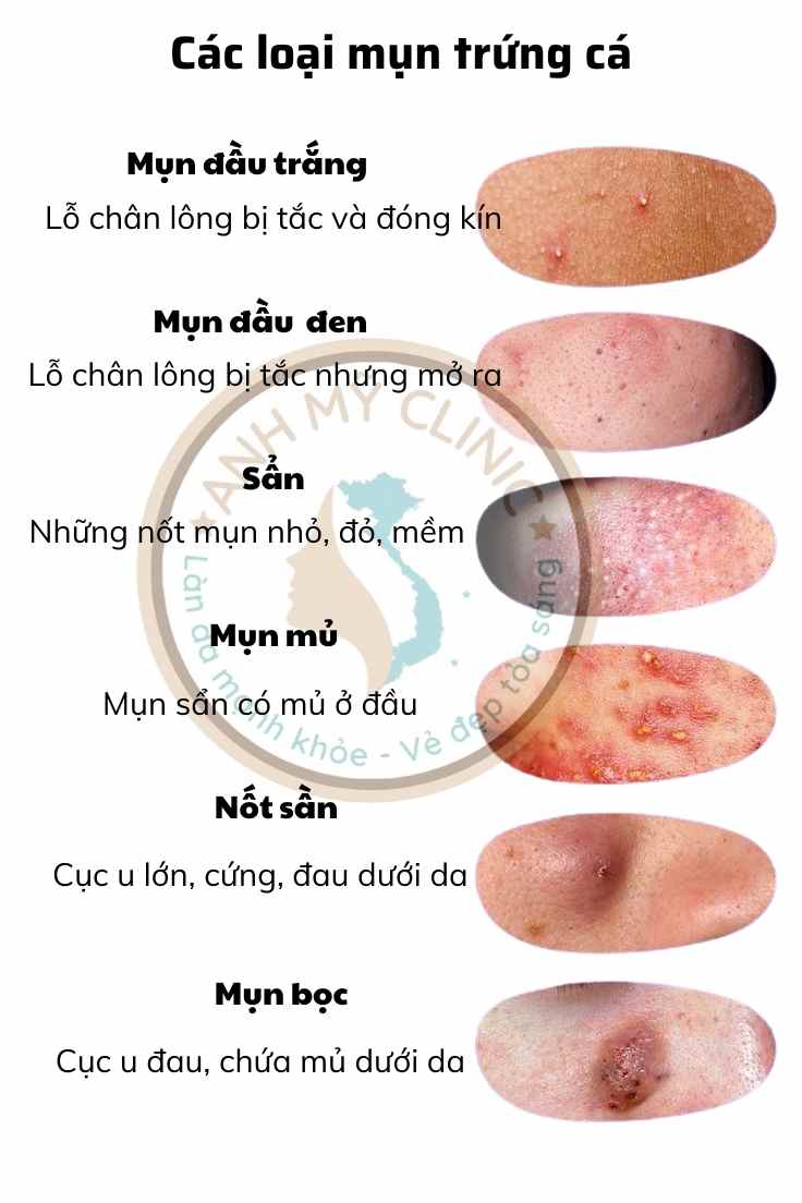 Các loại mụn trứng cá