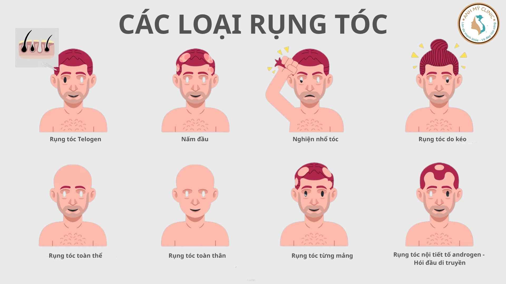 C&aacute;c loại rụng t&oacute;c