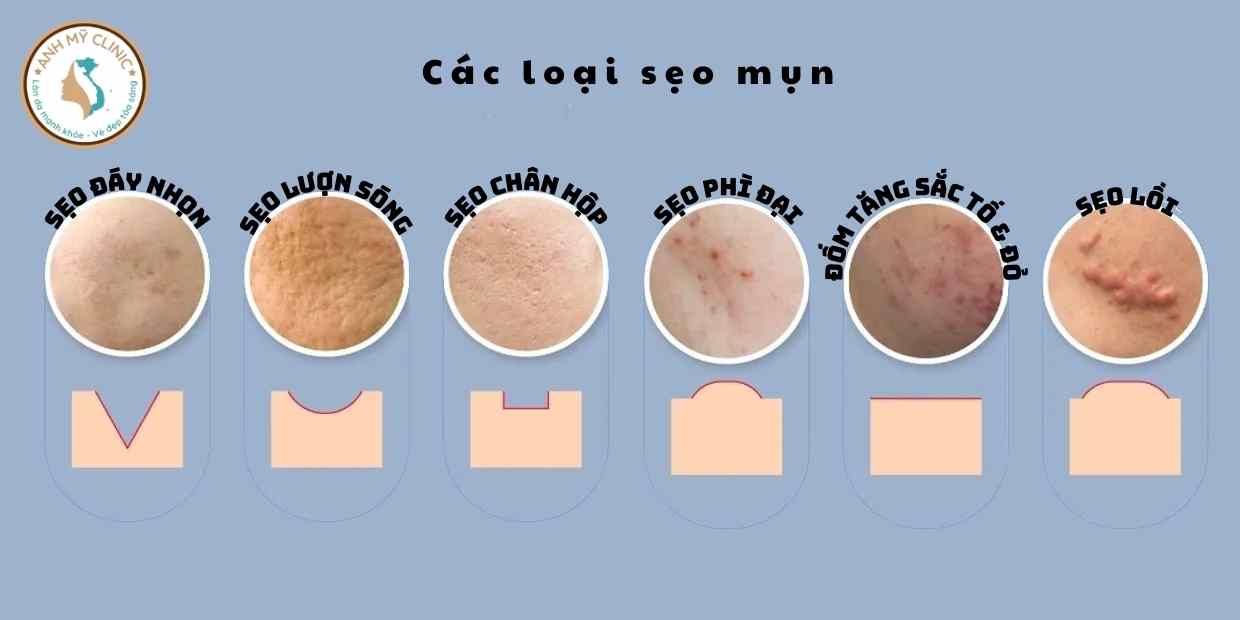 Các loại sẹo mụn