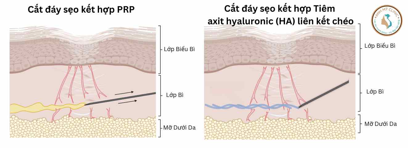 Cắt đáy sẹo kết hợp PRP / HA